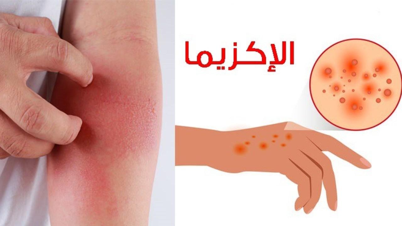 إحذروا.. هذه أخطر أعراض الإكزيما وجفاف الجلد