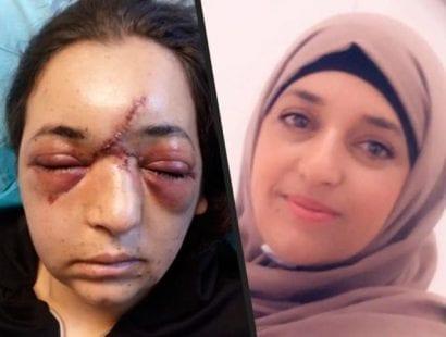 جندي من الاحتلال يتسبب بكسر في جمجمة سيدة فلسطينية بالعيسوية