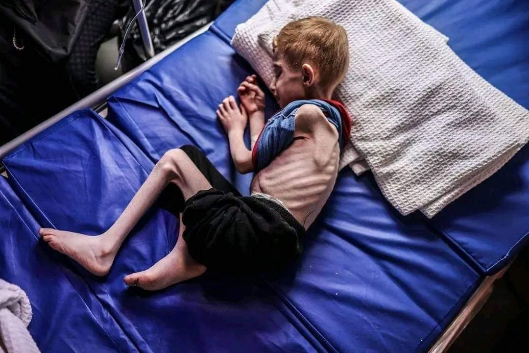 زيادة بنسبة 32 بالمئة في حالات سوء التغذية بغزة