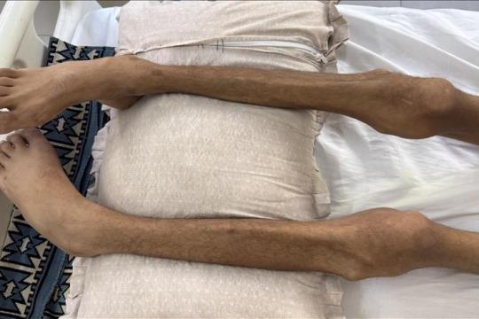 ارتفاع شهداء التجويع الإسرائيلي إلى 428 بينهم 146 طفلا